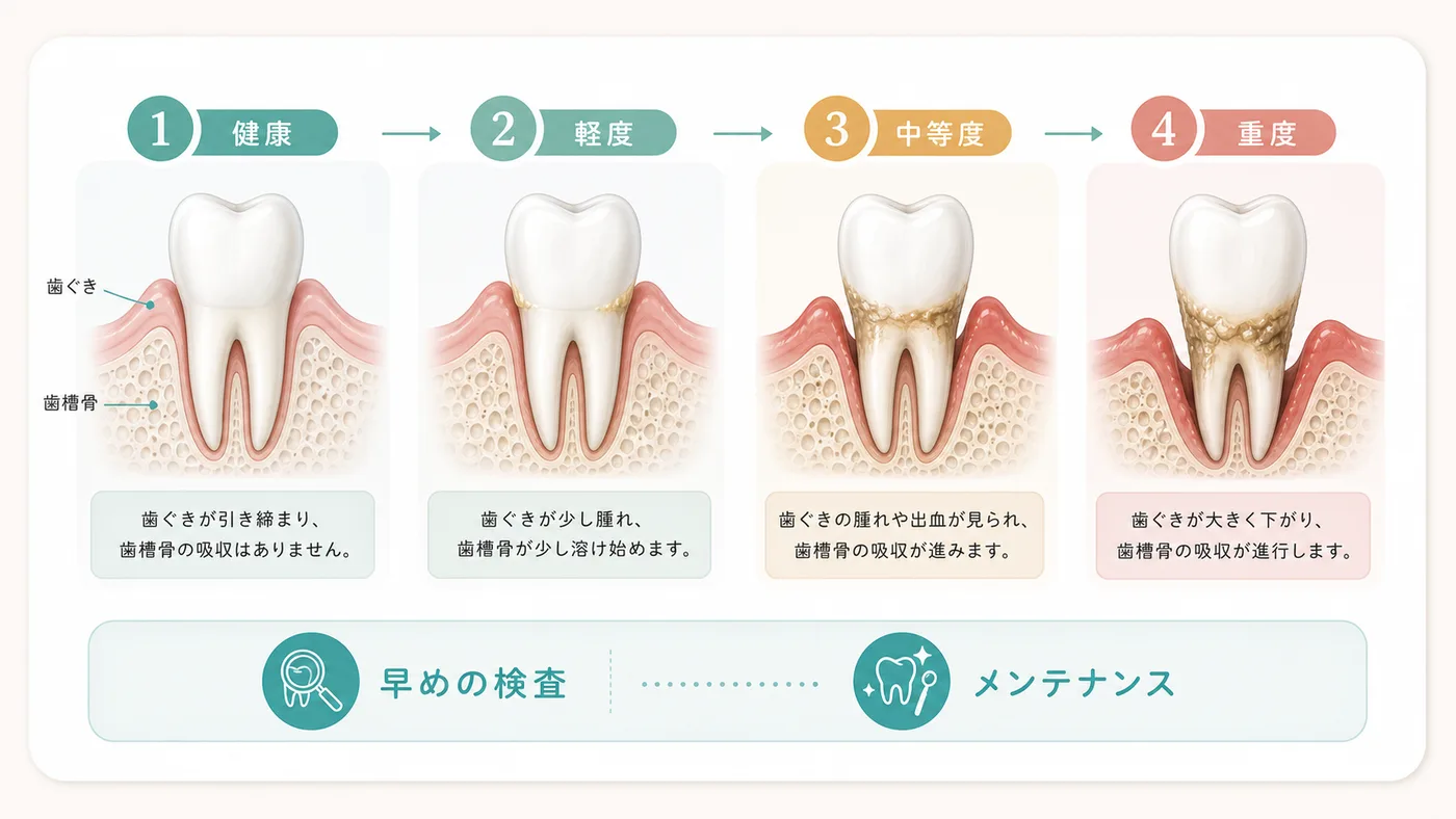 歯周病の進行段階 歯周病の進行段階